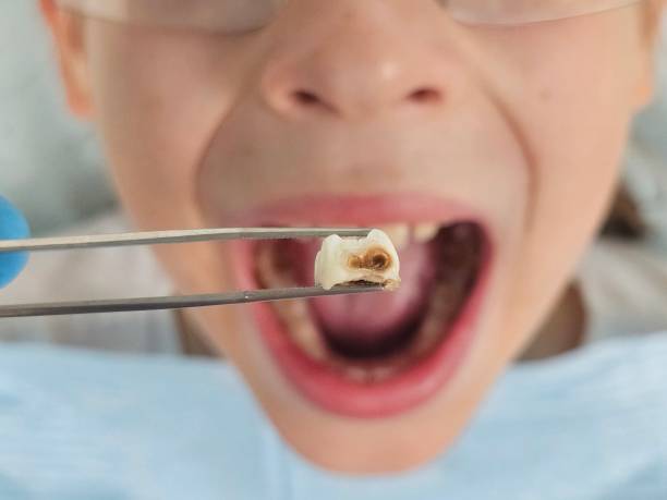 Best Broken or Chipped Tooth Repair in Boutte, LA